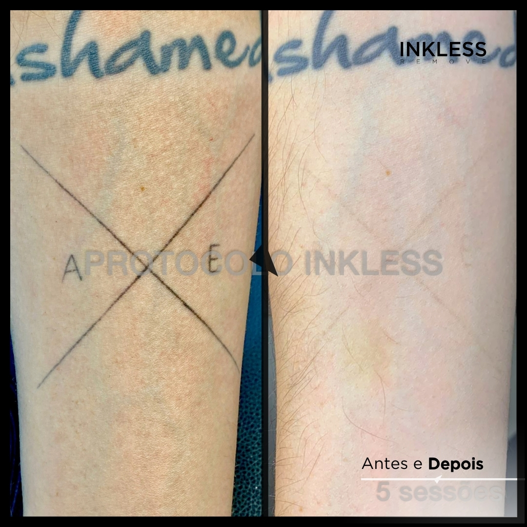 Resultado de remoção INKLESS - caso 3