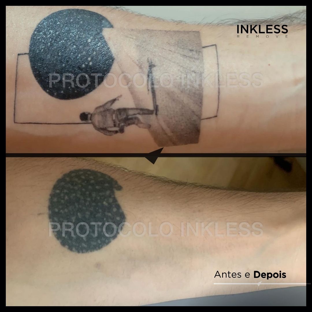 Resultado de remoção INKLESS - caso 4