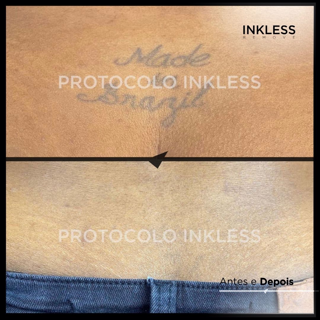 Resultado de remoção INKLESS - caso 5