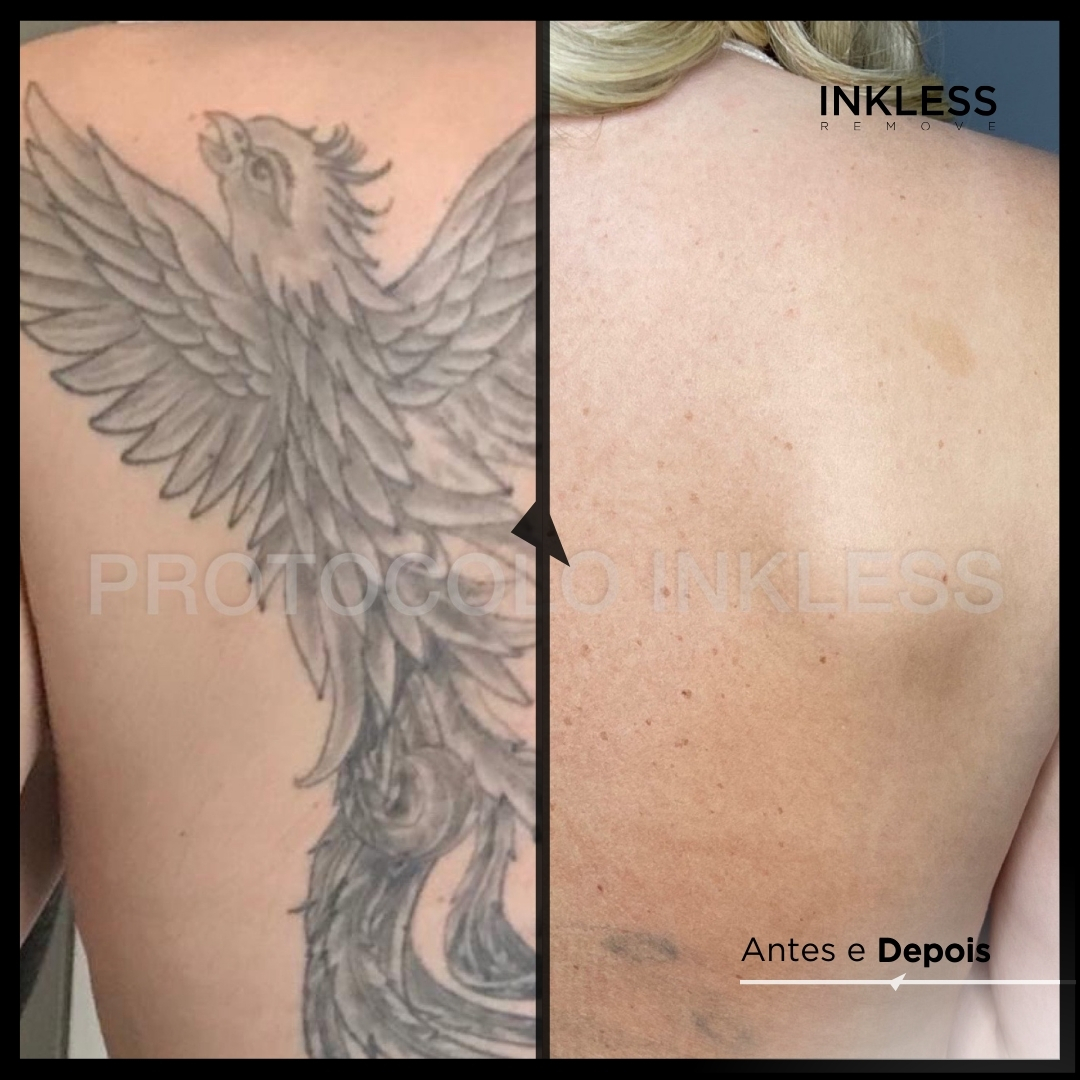 Resultado de remoção INKLESS - caso 7